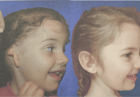 Before and after photos of young patient showing surgical implant results with improved appearance