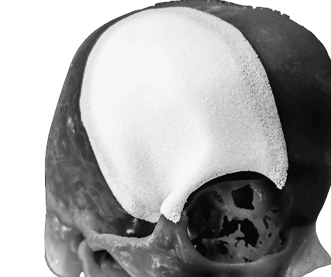 X-ray view showing white custom cranial implant fitted to skull anatomy