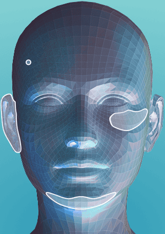 3D head model showing highlighted areas for SU-POR porous polyethylene facial implants