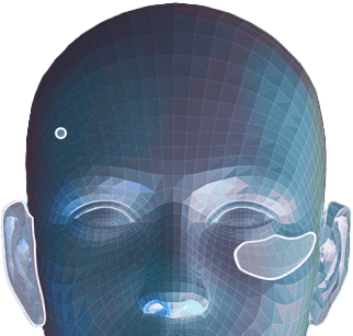 3D wireframe model of human head showing patient-specific implant planning for cranial orbital facial surgery using porous polyethylene
